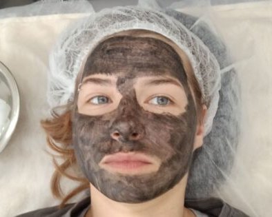 Какой эффект ждать от карбонового пилинга для лица